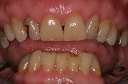 dental implants 60564