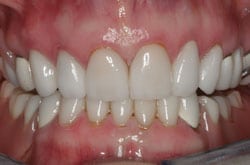 dental implants naperville