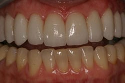 naperville dental implants
