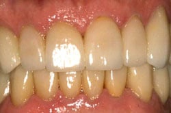 naperville implant dentistry