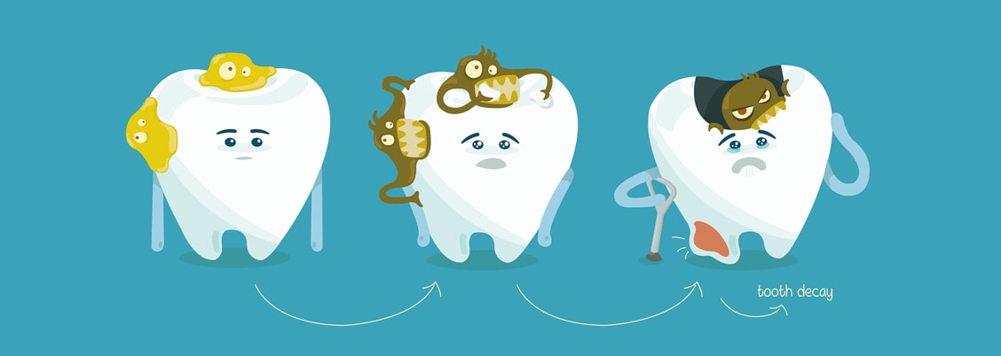 tooth decay graphic