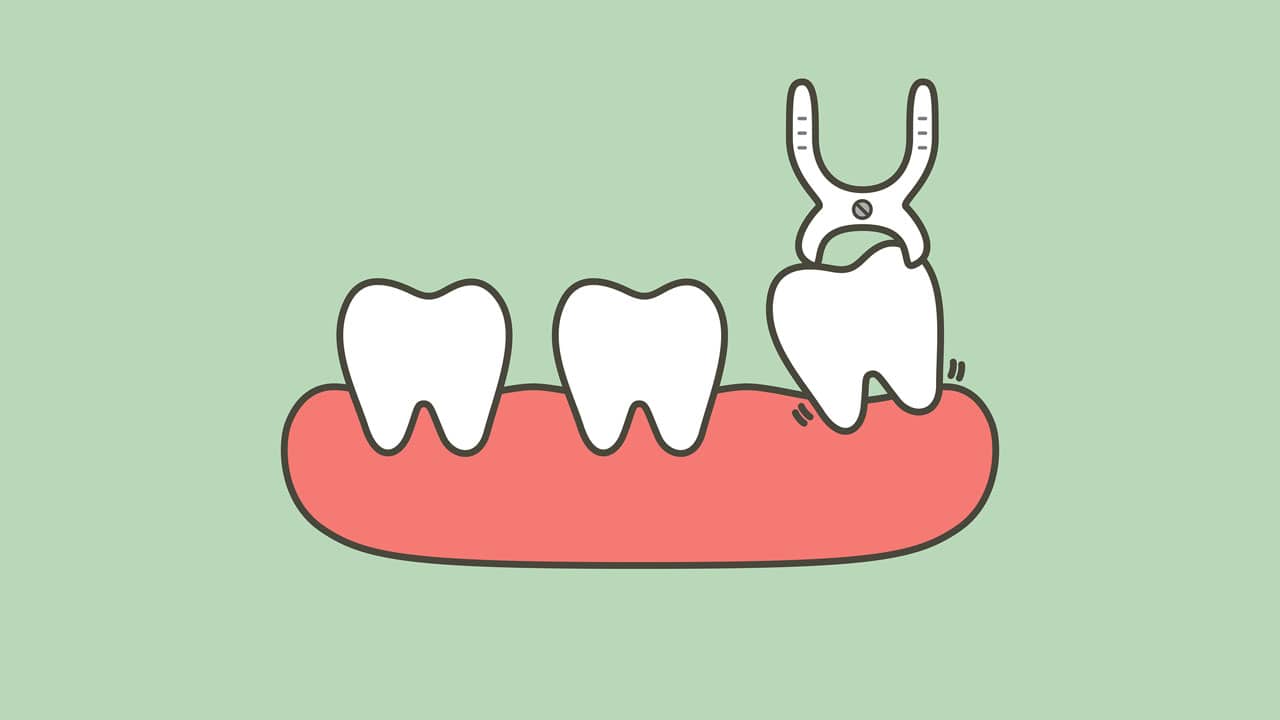 Simple vs. Surgical: The Two Tooth Extraction Methods—Explained! - Caputo  Dental
