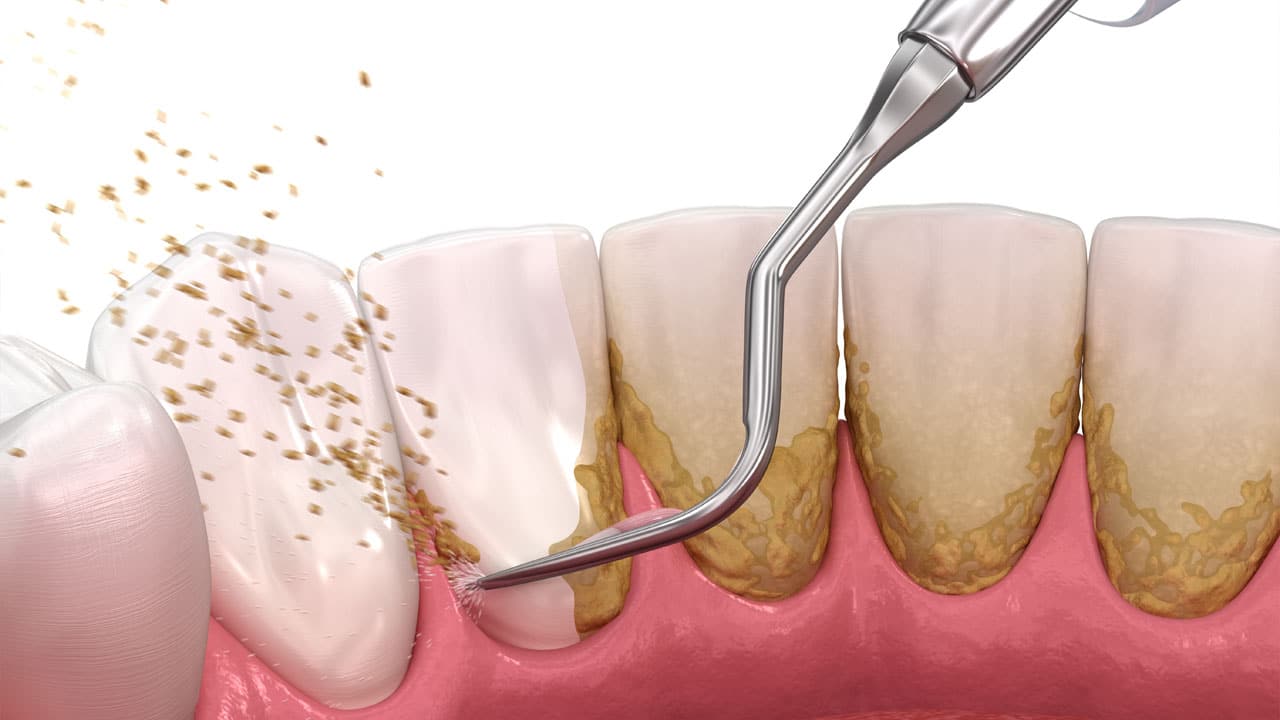 tartar breaking off back of teeth