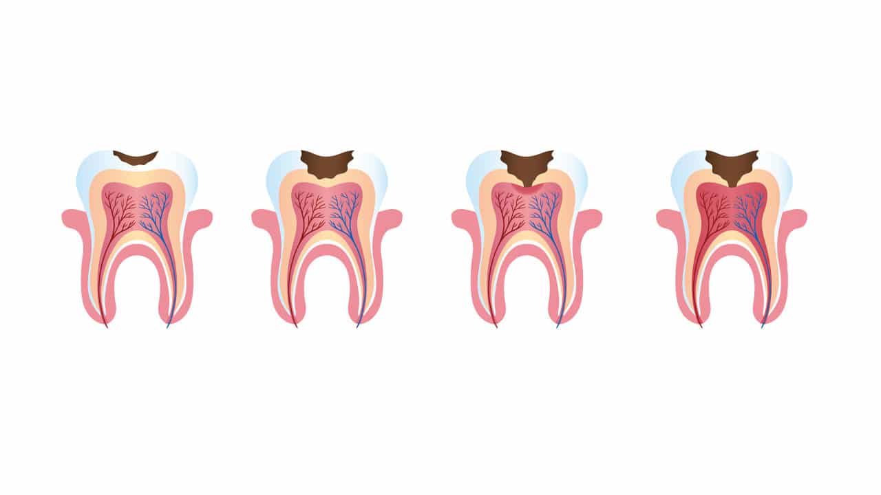 Graphic showing different stages of root decay