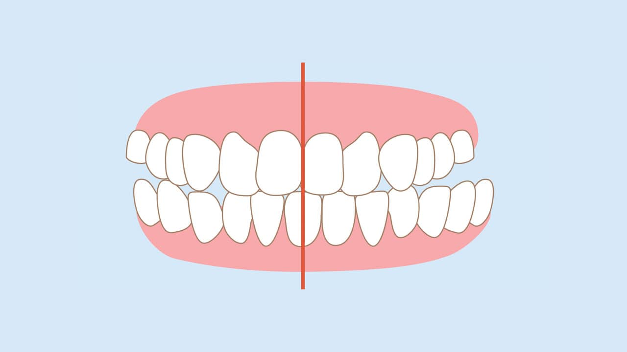 Graphic of a cross bite